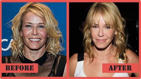 chelsea handler plastic surgery